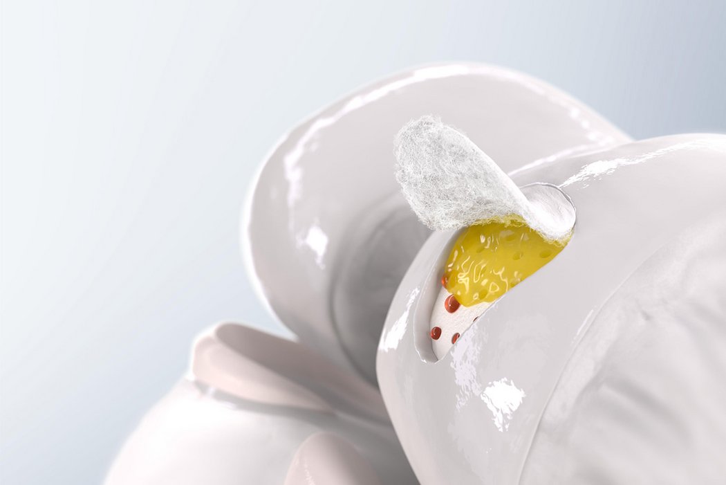 AMIC® + autologous adipose tissue