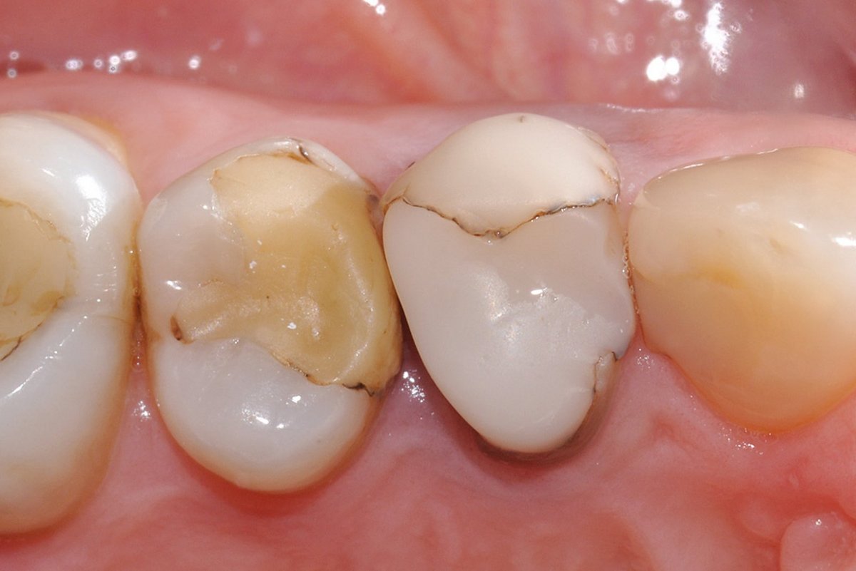 Early implant placement after Ridge Preservation - Geistlich Pharma AG