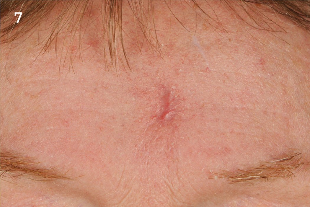 Geistlich_Hautchirurgie_Mucograft_Extraoral