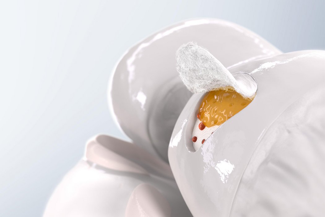 AMIC® + PRP
