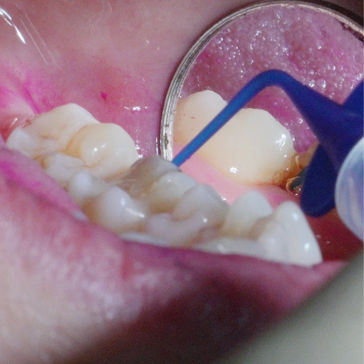 Pocket-X® Gel in non-surgical periodontal treatment - Geistlich