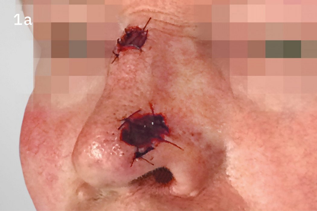 Geistlich_Hautchirurgie_Mucograft_Extraoral