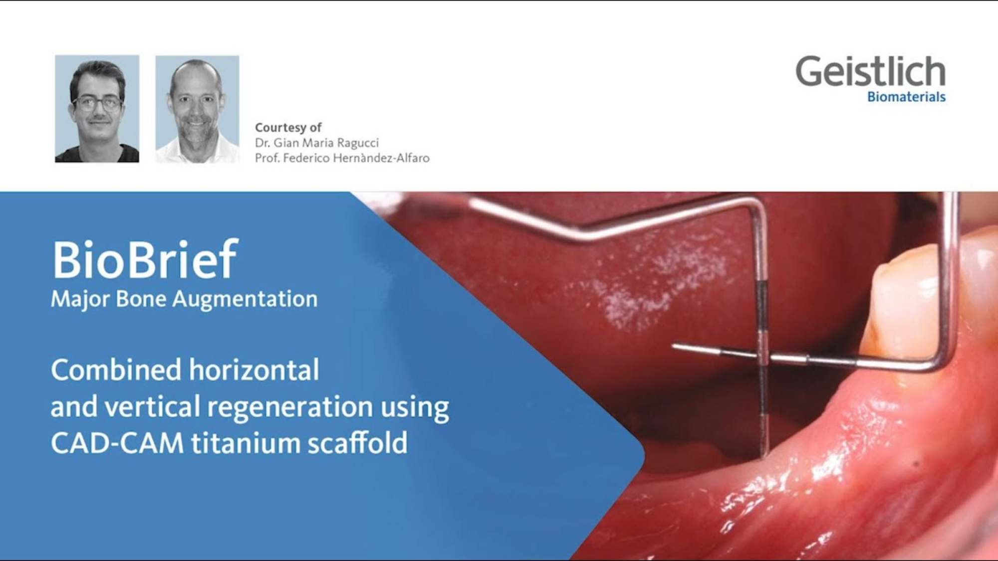 Combined horizontal and vertical regeneration using CAD-CAM scaffold ...