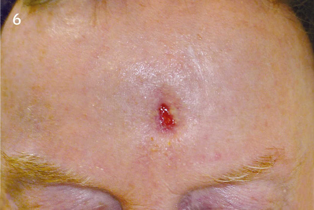 Geistlich_Hautchirurgie_Mucograft_Extraoral