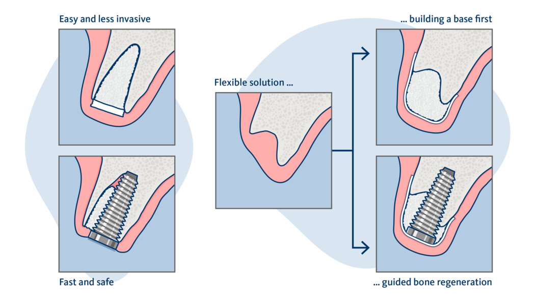 インプラント周囲のティッシュマネジメント 書籍 やさしい・失敗しない 低侵襲ソフトティッシュマネジメント
