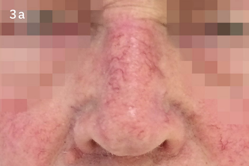 Geistlich_Hautchirurgie_Mucograft_Extraoral