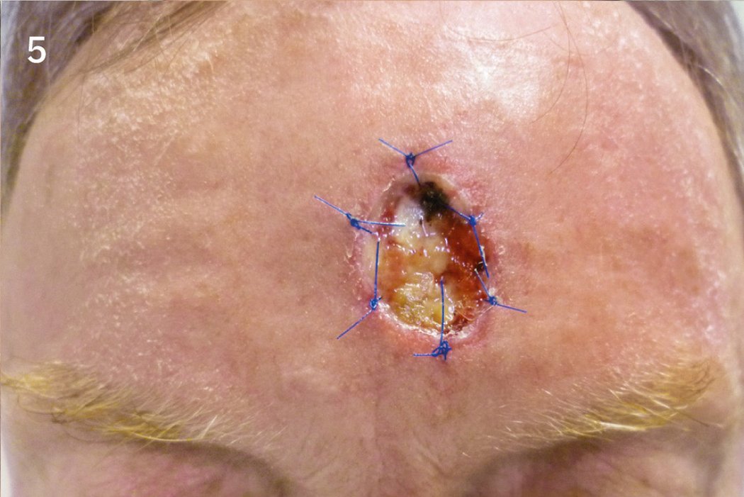 Geistlich_Hautchirurgie_Mucograft_Extraoral