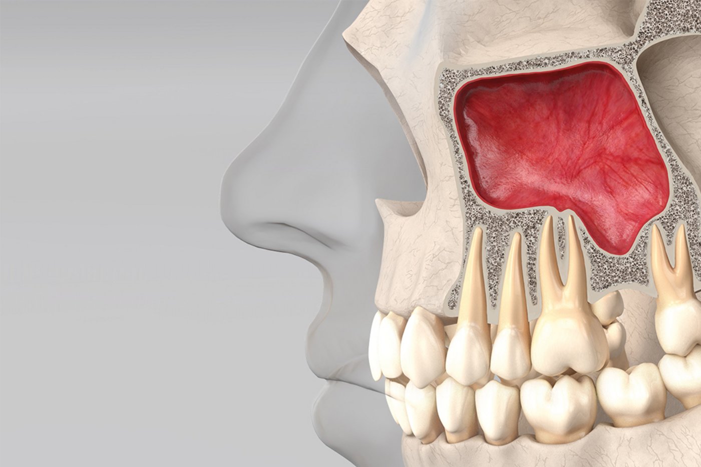 Sinus Floor Elevation Geistlich Pharma Ag