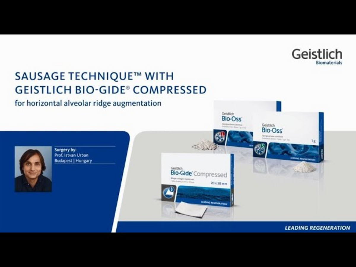 Sausage TechniqueTM with Geistlich Bio-Gide Compressed® for horizontal alveolar ridge augmentation