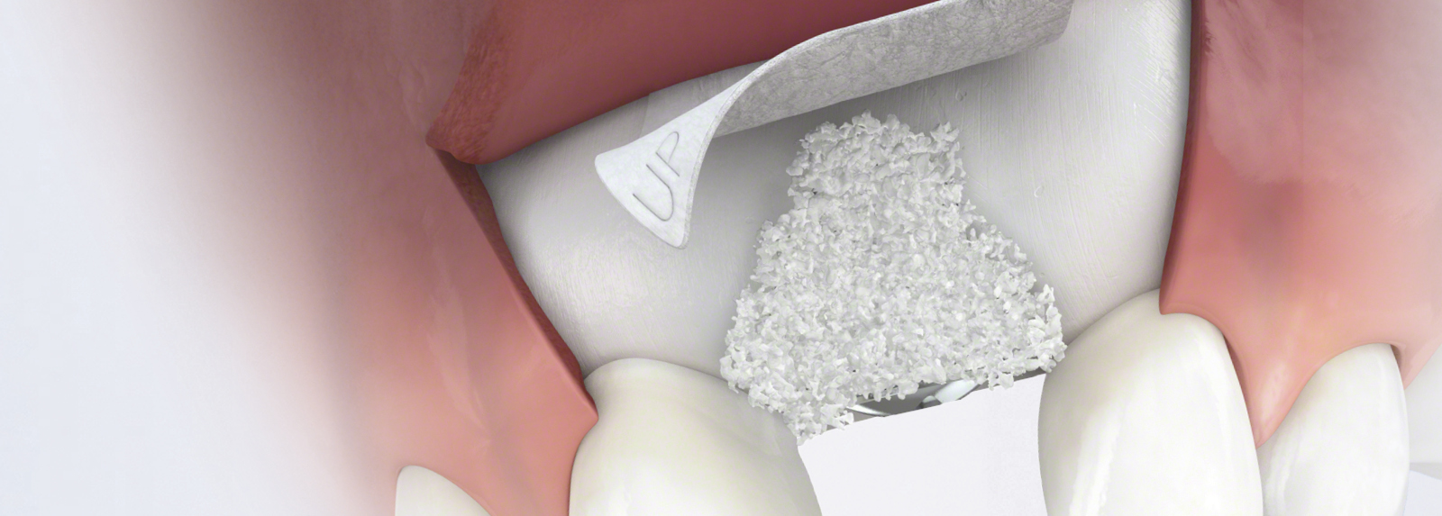 Case selection for immediate implant placement - Geistlich Pharma AG